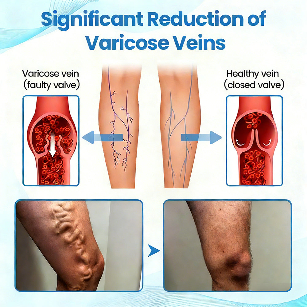 🇨🇦✨✨GFOUK® VascuCare Vein Healing Spray(Designed for Varicose veins, Spider veins, Deep vein Thrombosis, Chronic venous insufficiency, Venous ulcers, Thrombophlebitis and other venous issues)