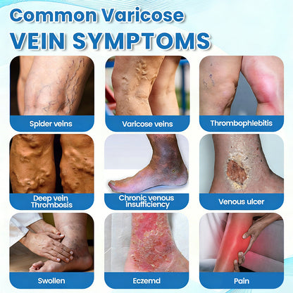 🇨🇦✨✨GFOUK® VascuCare Vein Healing Spray(Designed for Varicose veins, Spider veins, Deep vein Thrombosis, Chronic venous insufficiency, Venous ulcers, Thrombophlebitis and other venous issues)