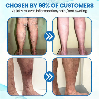 🇨🇦✨✨GFOUK® VascuCare Vein Healing Spray(Designed for Varicose veins, Spider veins, Deep vein Thrombosis, Chronic venous insufficiency, Venous ulcers, Thrombophlebitis and other venous issues)