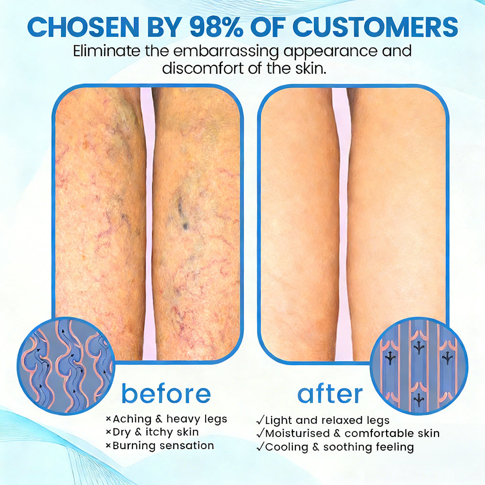🇨🇦✨✨GFOUK® VascuCare Vein Healing Spray(Designed for Varicose veins, Spider veins, Deep vein Thrombosis, Chronic venous insufficiency, Venous ulcers, Thrombophlebitis and other venous issues)