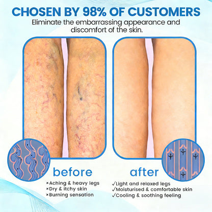 🇨🇦✨✨GFOUK® VascuCare Vein Healing Spray(Designed for Varicose veins, Spider veins, Deep vein Thrombosis, Chronic venous insufficiency, Venous ulcers, Thrombophlebitis and other venous issues)