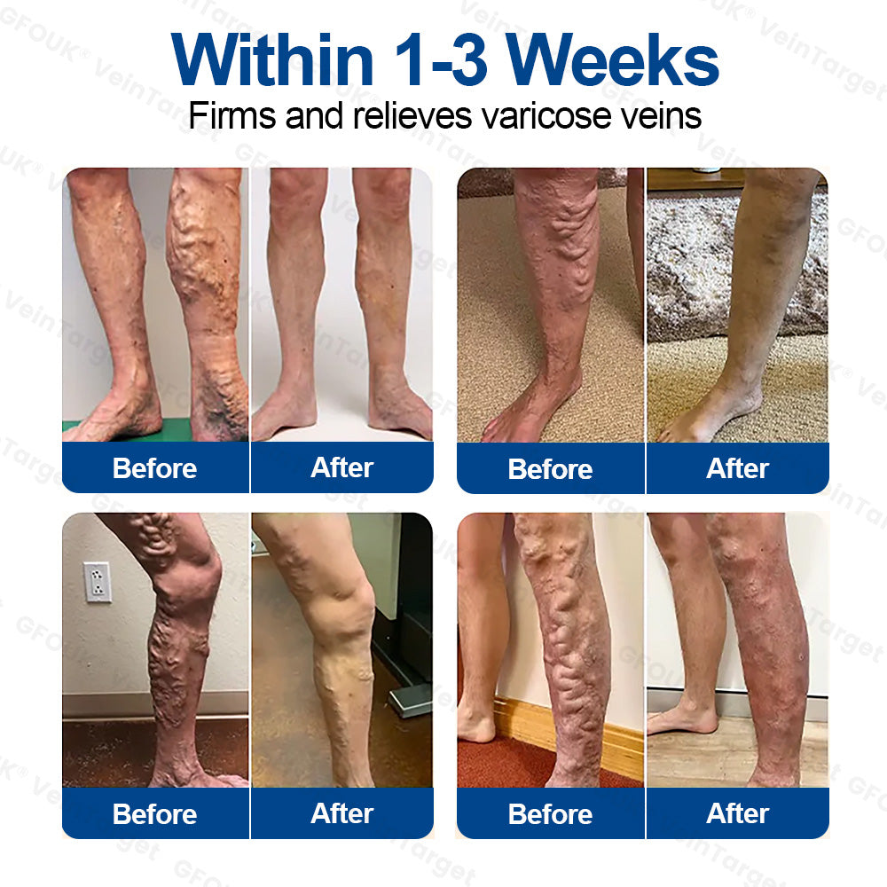 🇨🇦👨‍⚕️🦵✅GFOUK® VeinTarget Microneedle Patch⚡Instant Relief, Long-Term Results