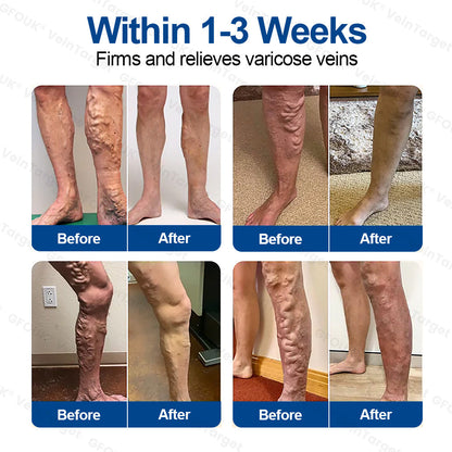 🇨🇦👨‍⚕️🦵✅GFOUK® VeinTarget Microneedle Patch⚡Instant Relief, Long-Term Results