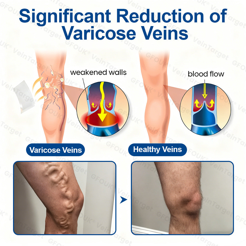🇨🇦👨‍⚕️🦵✅GFOUK® VeinTarget Microneedle Patch⚡Instant Relief, Long-Term Results